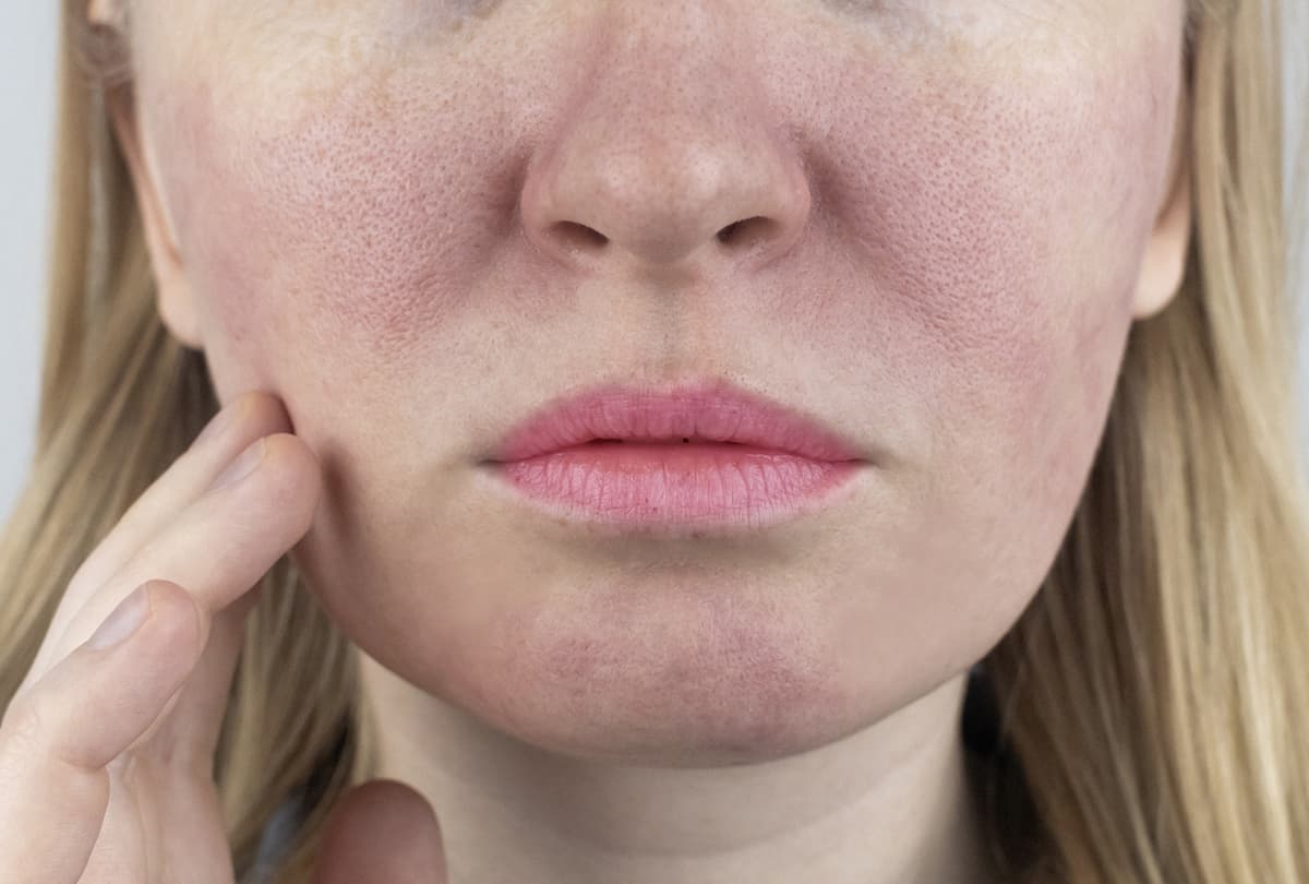 Rosacea & Redness