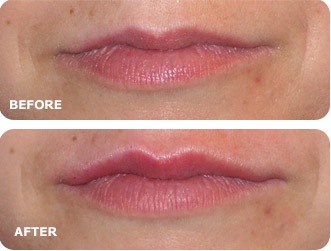 Client before and after lip filler injections.