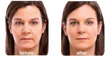 woman before and after soft lift treatment