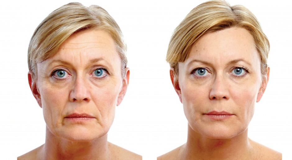 woman before and after soft lift treatment