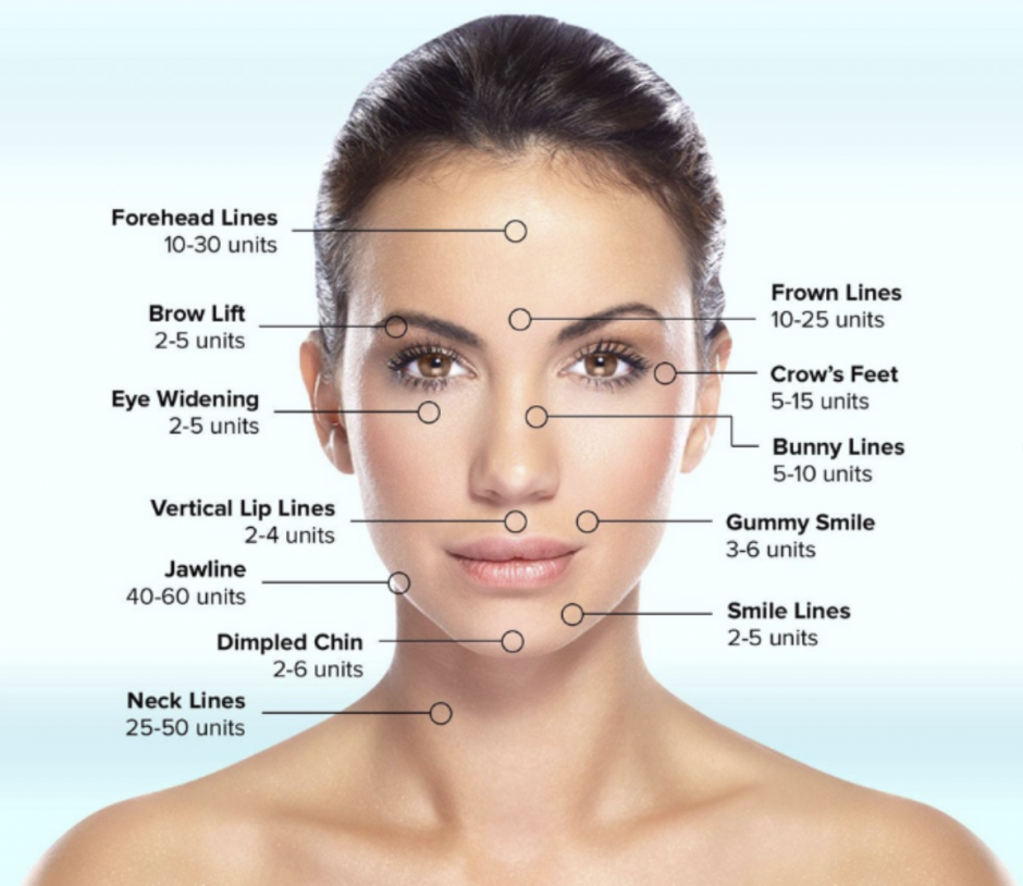 botox injection sites for the face