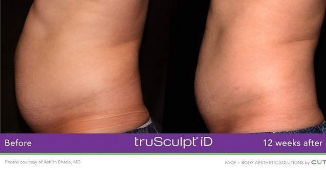 truSculpt Before & After