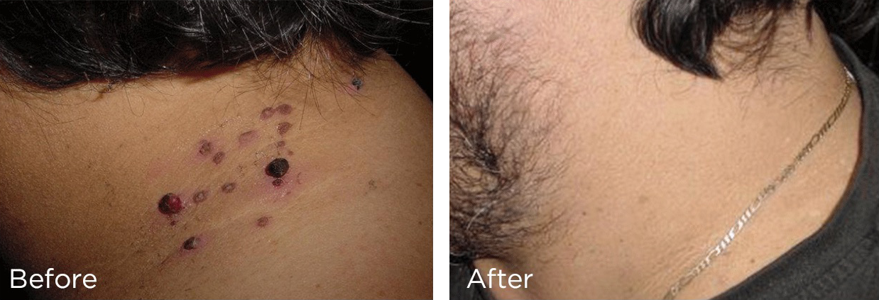 Before and After Cryotherapy Skin Treatment (Image provided by DermaSpark Products Inc.)