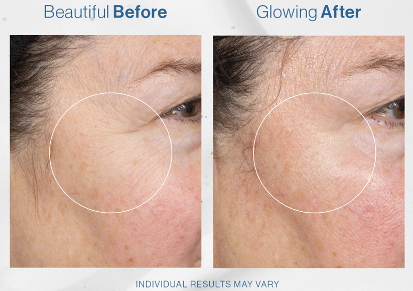 Hydrafacial provided before and after image showing the results of a Hydrafacial treatment