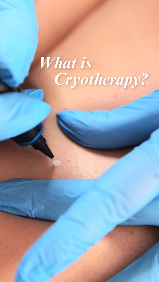 Cryotherapy is a precise, intentional treatment using controlled cold to safely treat unwanted benign skin lesions while protecting the surrounding skin ❄️

Each application is quick, targeted, and well-tolerated, allowing the body to naturally release the treated tissue with no anesthesia and no downtime.

Book a consultation to see if cryotherapy is right for you ❤️