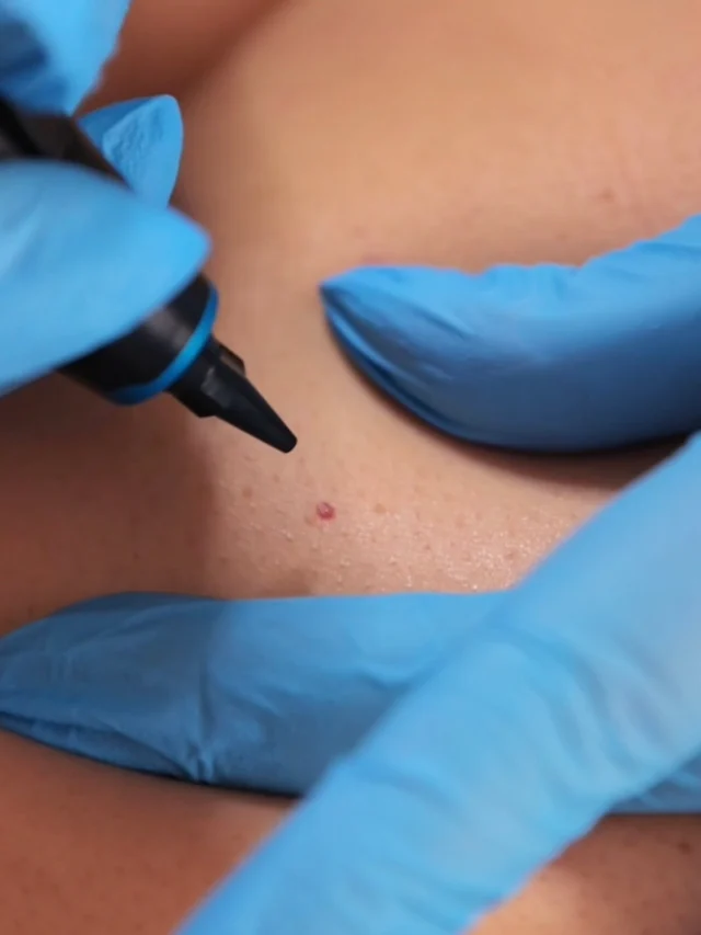 Sometimes it’s the small things that can impact our confidence the most.

One of the reasons our clients love the CryoProbe treatment is how quick, targeted, and effective it can be for concerns that have been bothering them for years.

For this client, it became part of feeling more comfortable and confident in her skin again after having babies.

Because personalized care isn’t just about appearance. It’s about helping people feel like themselves again ✨